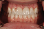 Fig 14. The patient’s smile 2 weeks after insertion.