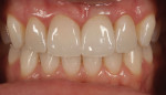 Fig 15. The patient’s smile 2 weeks after insertion.
