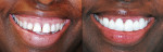 Figure 14  Before treatment and after gingival recontouring and placement of the functional mock-up showing the correction of the gummy smile and esthetic improvement.