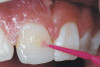 Figure 12   Images show the benefits of a modern, conical, polished dentin access shape that is now possible with a modern endodontic access bur. Note how the smooth cone helps the file find its way into the tiny RPT.