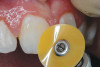 Figure 13   Preoperative view of calcified tooth that had been discolored for 25 years.