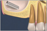 Fig 1. Illustration of an aberrant dental implant located in the SCS. For this invasion to have occurred, the Schneiderian membrane must have been perforated.