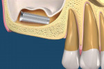 Fig 2. Illustration of an aberrant dental implant located in the SMS. Creation of, and invasion into, this space does not require perforation of the Schneiderian membrane.