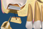 Fig 4. The trapezoidal block is carefully removed, but not discarded, to expose the implant or object.
