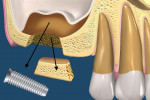 Fig 5. Creating and removing the trapezoidal block facilitates visualization and removal of the invading implant or object.