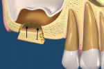 Fig 6. The tapered, trapezoidal cut pattern facilitates replacement and stabilization of the block, with primary closure achieved with only the gingival flap.