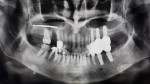 Fig 7. Radiograph confirming the location of a high-speed bur accidentally dropped into the sinus cavity.