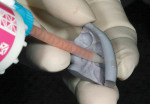 Figure 7  Conservative filling of the tooth form with bis-acryl temporary material.