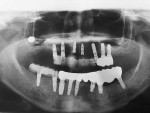 Fig 11. After 1 week, the implant fixture had fallen into the SCS.