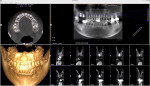 Fig 13. Following a TTO procedure, two dental implants were immediately placed according to the HSC technique, their placement stability was confirmed, and the health of the sinus areas verified.