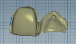 Fig 4. CAD/CAM of restoration-dimple captured.