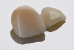 Fig 8. Finished case with veneering feldspathic porcelain placed to match adjacent central incisor.