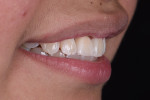 Fig 14. Final smile, right lateral view.