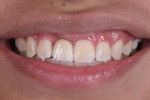 Fig 16. Final smile, anterior view.