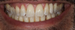 Fig 18. Tooth No. 11 replaced by resin-bonded cantilever zirconia bridge.