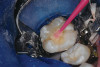 Figure 18   Cavosurface outline for modern incisor access. PCD can be consistently safeguarded with this changed approach.