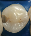 Figure 1a  The adhesive preparation for composite restorations allows a more conservative design than its amalgam counterpart.