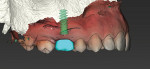 Fig 6. Planned implant position and crown diagnostic design, lateral view.