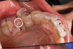 Fig 8. Surgical template placement, occlusal view.