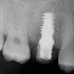 Fig 14. Periapical radiograph showing implant placement and immediate loading.
