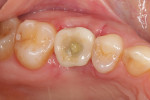 Fig 15. Two-week follow-up of provisional restoration.