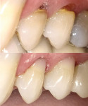 Pre- and post-treatment (immediately after placement) photographs of FIT SA™ restorations.
