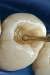 Figure 2d  An A3 shaded flowable composite was applied as a cavity liner and uniformly distributed on the pulpal floor with a ball-tipped instrument.