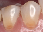Figure 3a  The direct bonding duo-shade technique is used in cases where noncarious cervical lesions are present (eg, saucer-shaped noncarious cervical lesions on the mandibular right premolars).