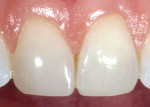 Figure 4c  The composite restorations using the simplified duo-shade placement technique were completed with satisfactory results in a simpler, shorter period of time than would have been the case if another method had been used.
