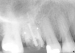 Figure 1  Radiograph of the abutments before preparation.