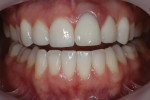 Pretreatment retracted photograph with the teeth apart showing visible soft-tissue swelling associated with a root fracture on tooth No. 9. The examination also revealed the presence of a flat, canted smile line, ratio discrepancies in terms of lengths and widths, deficient buccal corridors, and asymmetry among the gingival zeniths.