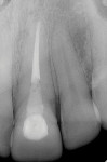 Pretreatment radiograph of the existing root canal-treated tooth No. 9 exhibiting the vertical root fracture.