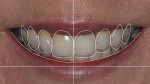 Digital smile design overlayed on the existing smile to assist in planning where the ideal incisal edge positions should be for the new smile. After assessing a 3D cone beam computed tomography (CBCT) image, the removal of tooth No. 9 was planned, and immediate tooth replacement with a dental implant in the ideal position was possible. It was important to ensure that the site would allow osseous support to accommodate a future interdental papilla and col. To facilitate this, a staged treatment approach with multiple future grafting procedures would be required.