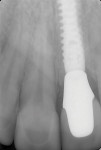 After removal of all of the chronic granulomatous tissue, the implant (NobelActive® RP 4.3 mm x 18 mm, Nobel Biocare) was placed. No grafting procedures were performed during this visit. This permitted visualization of where the natural osseous and soft-tissue limitations would be after initial healing.