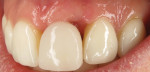 A complete absence of tooth No. 9’s distal interdental papilla can be seen here after 3 months of healing.