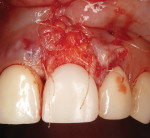 Two types of soft tissue (subepithelial connective tissue from the palate and a denser type of soft tissue from the maxillary tuberosity area) were harvested for the initial soft-tissue grafting procedure (Monosyn® Quick 5/0 DS12 45 cm Undyed 3/8 Circle Rev Cut sutures, B Braun Aesculap) in an attempt to increase the amount of keratinized mucosa at the cervical boundary of the new crown and simultaneously coronally advance the soft-tissue profile.