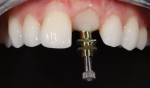 The next phase of treatment was temporization, which guided and trained the soft tissue to sit in a more favorable position and develop an emergence profile that would present a more natural appearance and be conducive to good oral hygiene as well (Impression Coping Open Tray Conical Connection RP [3.6 x 14 mm], Nobel Biocare; G-ænial® Universal Flo [shade A2], GC America).