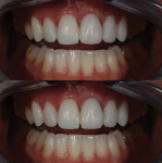 Minor changes were made during the period of temporization (Structur 3 [shade B1], VOCO). The design was evaluated using digital photography, and the patient was allowed to provide input. While reconstructing the lost hard and soft tissue at the tooth No. 9 site, changes were made to create symmetry in the gingival zenith positions and ultimately in the appearance of teeth Nos. 8 and 9.