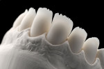 Image of the pressed porcelain framework (IPS e.max® Press LT [shade BL2], Ivoclar Vivadent) before layering and staining. Working closely with a master dental technician helped tremendously in achieving the final highly esthetic result (laboratory work completed by Szabi Hant, MDT).