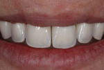 Try-in of the porcelain restorations to evaluate the lip relationship to the incisal edges in repose.