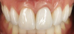 After the final porcelain restorations were inserted and a 6-month healing period was allowed for the final soft-tissue profile to develop, a small soft-tissue defect was noted around the zenith of the implant crown in position No. 9.
