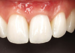 Close-up follow-up photograph of the implantretained crown at site No. 9 taken 2 weeks after the initial healing period and suture removal visit. Note the improved position and contour of the soft tissue around the gingival zenith of the crown.
