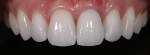 Posttreatment close-up maxillary photograph of the porcelain restorations demonstrating the improved smile line, buccal corridor progression, and a feminine and youthful appearance with life-like esthetics.