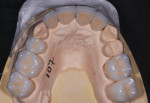 Maxillary and mandibular stone models, respectively, showing the indirect lithium disilicate restorations and the remaining stone teeth that would receive direct composite restorations.