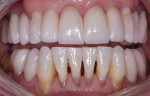 Retracted photograph with the teeth apart following delivery of the indirect restorations but before the direct restorations were completed.