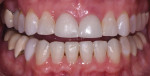 Postorthodontic treatment retracted photograph with the teeth apart. Note the coronal gingival position of teeth Nos. 8 and 9. The biologic width violation has been resolved, but they are still lacking in gingival symmetry.