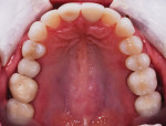 Postorthodontic treatment views of the maxillary and mandibular arches.