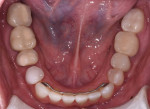 Postorthodontic treatment views of the maxillary and mandibular arches.
