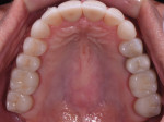 Posttreatment views of the maxillary and mandibular arches. Note the blend of contour and color of the indirect restorations and the direct restorations on teeth Nos. 5, 6, 11, 12, and 22 through 27.