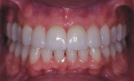 Posttreatment retracted views with the teeth in the maximum intercuspation position and apart. Note the gingival symmetry, more idealized tooth proportions, and blend of color.